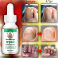 NAILS SERUM FOR NAIL GROWTH & REPAIR, FUNGAL INFECTION, ANTI-INFECTIVE REMOVAL PARONYCHIA ONYCHOMYCOSIS